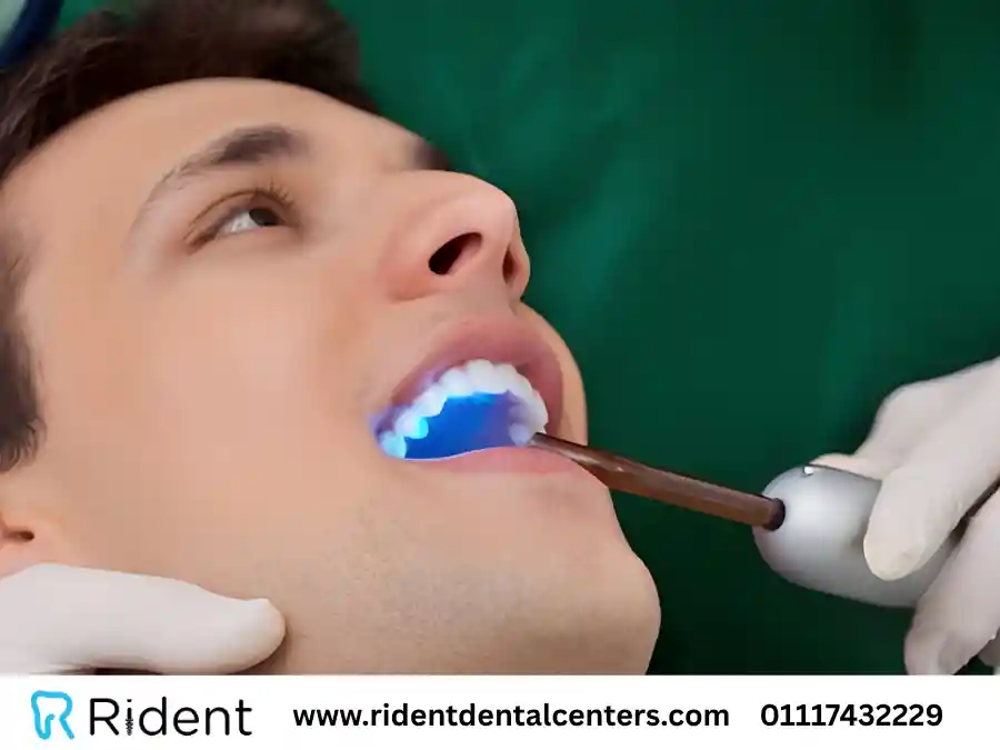 6 مميزات لـ حشو الأسنان بالليزر وما العيوب؟